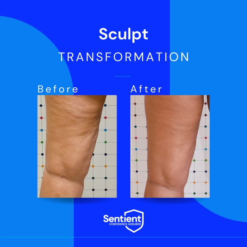 Before and after Sentient Sculpt cellulite treatment — clinical study results